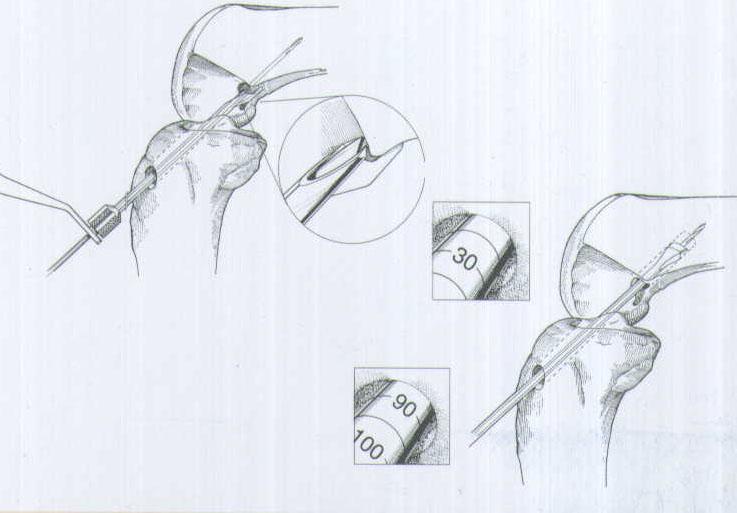 肌腱韌帶固定系統注冊技術審查指導原則（2020年第36號）(圖1)